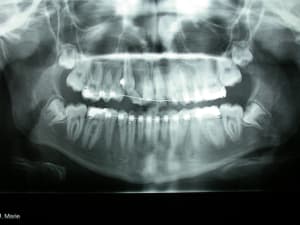 Canine incluse tlkemp - Eugenol