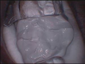 Cerec3 anhzje - Eugenol