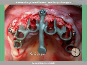 Chirurgie guidée mise en charge immédiate 0011 xmgnvv - Eugenol