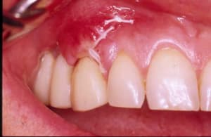 Cica opotea - Eugenol