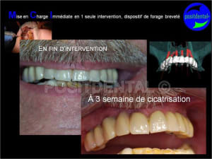 Cicatrisation gingivale suite mci positdental 2 jmuj5e - Eugenol