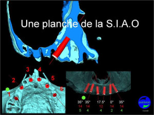 Cicatrisation gingivale suite mci positdental 3 tj6tza - Eugenol
