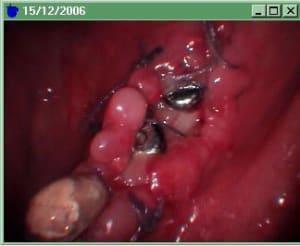 Complication ggocwo - Eugenol