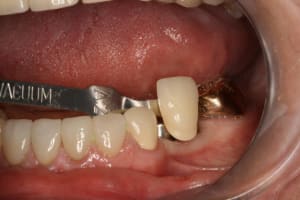 Couleur implant 34 35 cv03dl - Eugenol