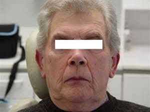 Début de traitement ehrmnx - Eugenol