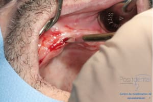 Déoulé d une mci dr r - Eugenol