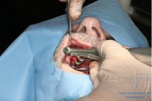 Déoulé d une mci dr r - Eugenol