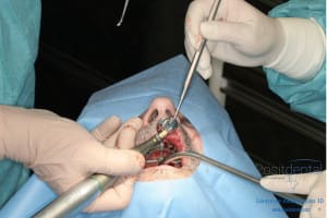 Déoulé d une mci dr r - Eugenol