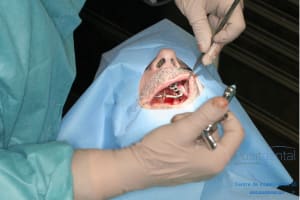 Déoulé d une mci dr r - Eugenol