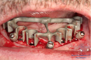 Déoulé d une mci dr r - Eugenol