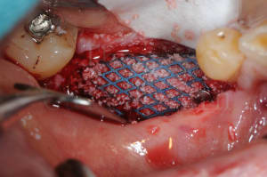 Dentiste implant mondelange 3 gi8xpy - Eugenol