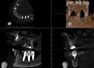 Dentiste mondelange implant ot55j9 - Eugenol