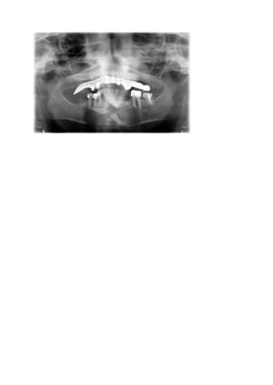 Dents incluses2 jlyl1r - Eugenol