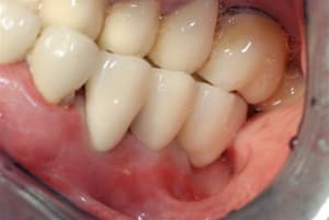 En occlusion y5jfdz - Eugenol