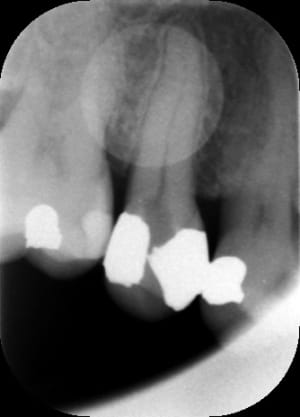 Endo1 muyihn - Eugenol