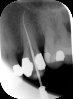Endo2 ijoihl - Eugenol