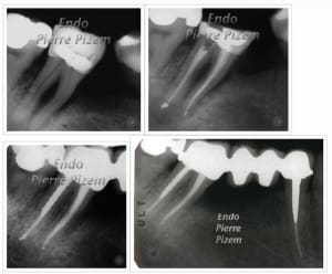 Endo 47 pf4d2j - Eugenol