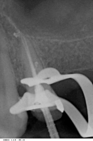Endo après h5gqnq - Eugenol