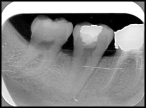 Endo xlrfpk - Eugenol