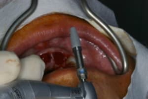 Exo implantation sans lambeau rfmpfg - Eugenol