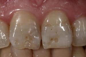 Facette  1  toe21m - Eugenol