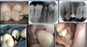 Fracture 15 pas de 14 gnzss1 - Eugenol