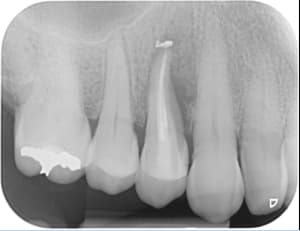 Fracture gkjg7l - Eugenol