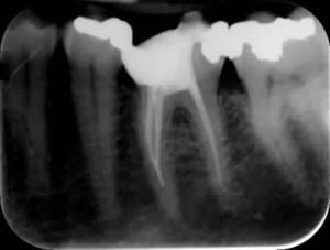 Fracture kaeyte - Eugenol
