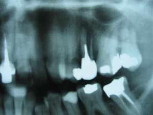 Fracture vt1rdw - Eugenol