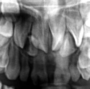 Geminationpano rhwait - Eugenol