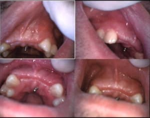 Greffe prémaxillaire à 15 jours exysvd - Eugenol
