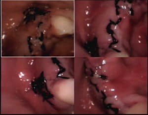 Greffes osseuses jour 3 b yhldzq - Eugenol