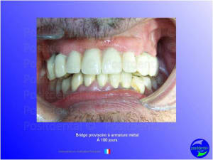Guide chirurgical   mise en charge imm diate 016 n313fk - Eugenol
