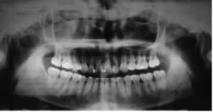 Impacted5 sciemd - Eugenol