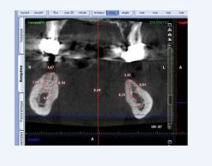 Implant 36 46 xlhhgu - Eugenol