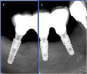 Implant etroit diqe4b - Eugenol