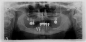 Implant h6jvda - Eugenol