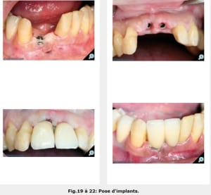 Implants pele vntckj - Eugenol