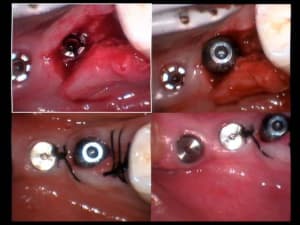 Implants aurélia 02 04 2005 sutures ngovrx - Eugenol