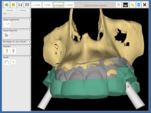 Implants canines 2 rpkqdn - Eugenol