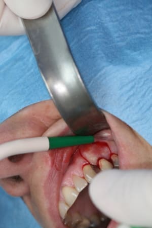 Incision2 dd0trg - Eugenol