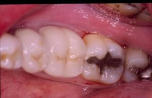 Initial abadeg - Eugenol