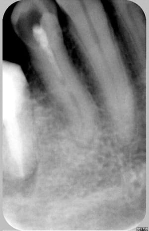 Initial calcification a demi racine jex10o - Eugenol