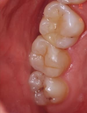 Inlay 2 cpn0vo - Eugenol
