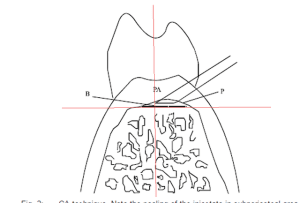 Intraseptalaxe oadvly - Eugenol