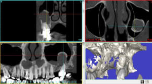 Kyste aper u ksbuzo - Eugenol