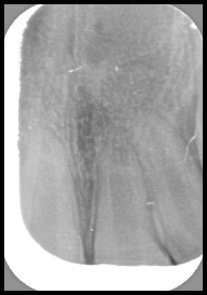 Lap tite ht0crp - Eugenol