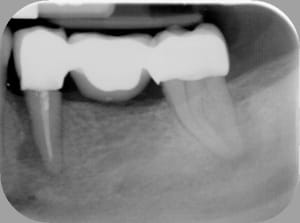 Lesion endopoaro udxc5l - Eugenol