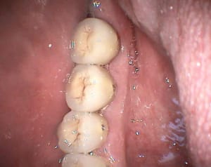 Linguale mbjnnq - Eugenol