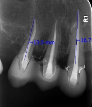 Longueur radiculaire apr s sphl8f - Eugenol